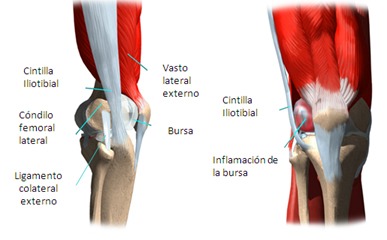 Rodilla del corredor