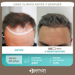 microinjerto capilar en Jerez, Sevilla, Córdoba y Granada
