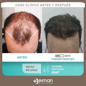 Injerto capilar en Jerez, Sevilla, Córdoba y Granada