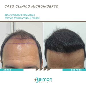microinjerto capilar en Sevilla